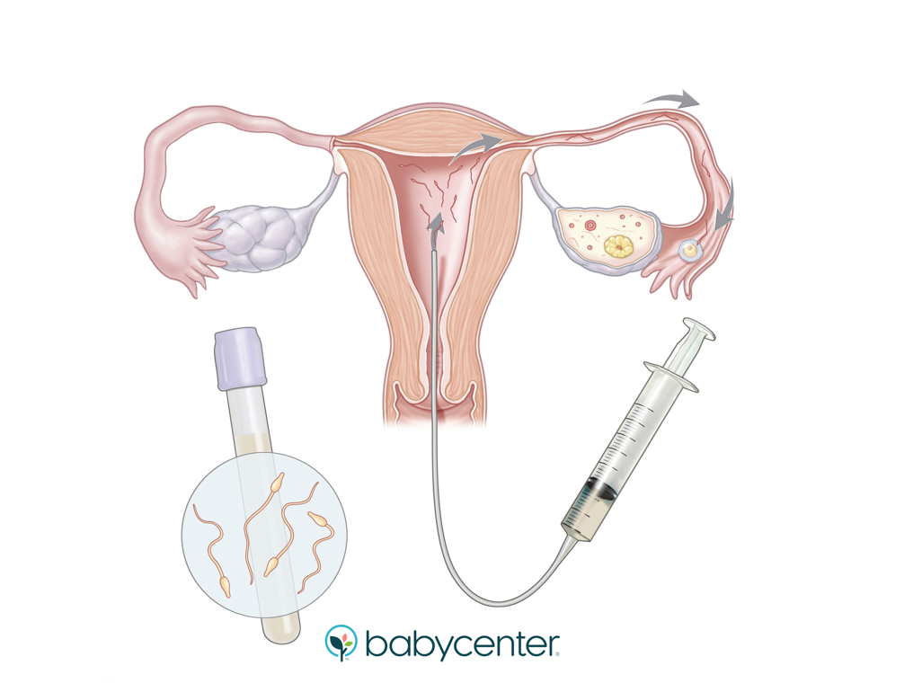 illustration of intrauterine insemination